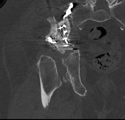 Acetabular Fracture Failed ORIF CT 1